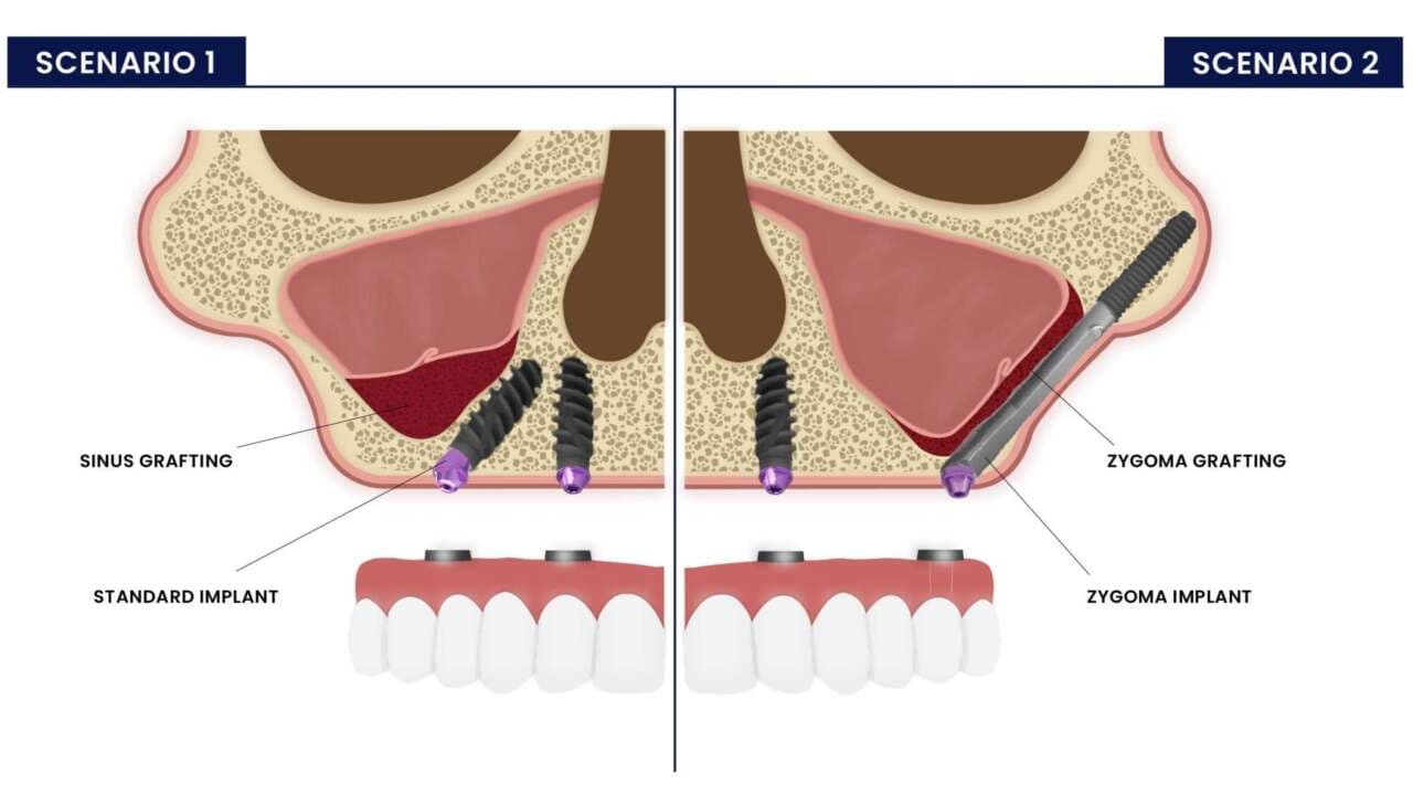 Zygomatic Implants