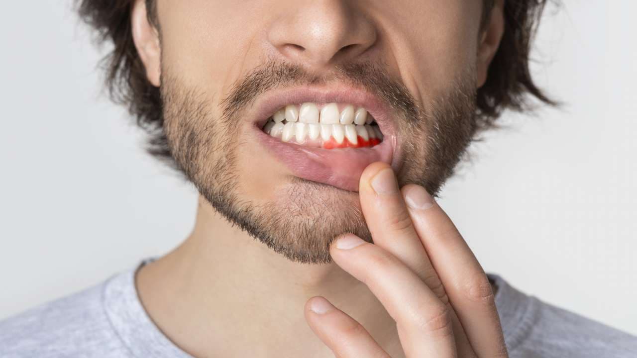 3 reasons you may have bleeding gums
