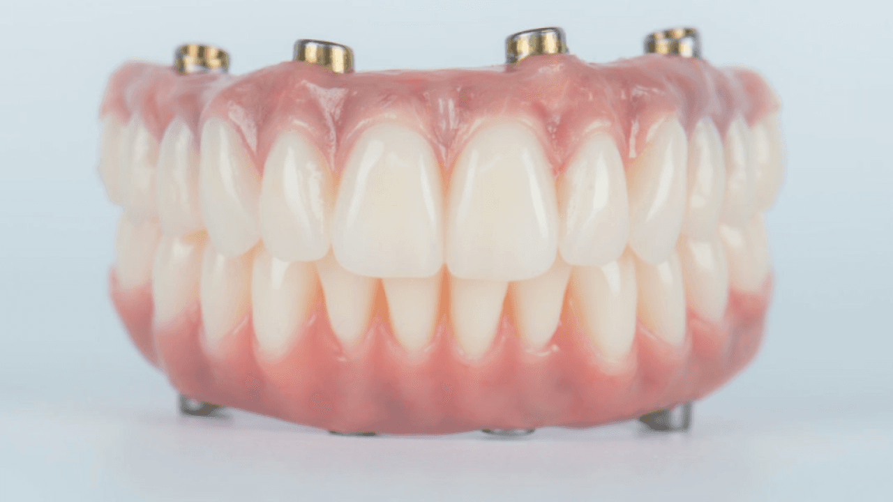 All On 4 Dental Implants, Why They Might Be The Right Choice For You