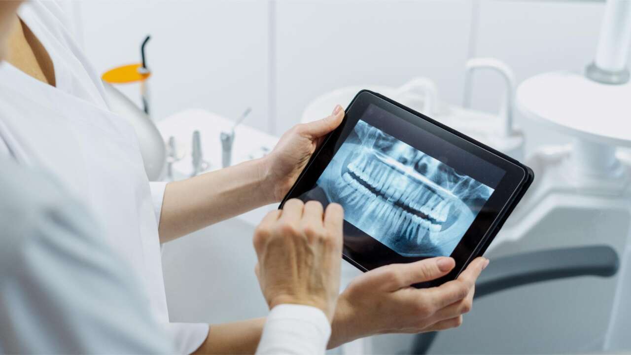 Reasons why you may need All On 4 Dental Implants