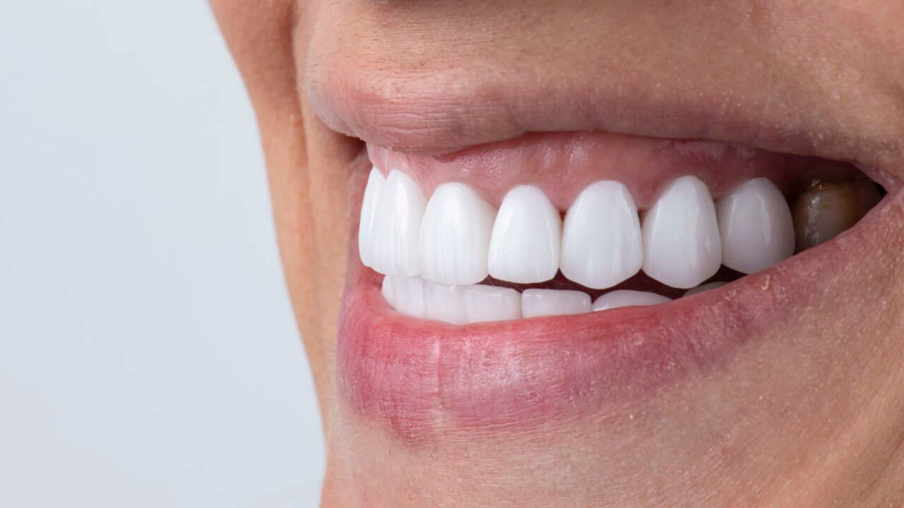 Porcelain Veneers