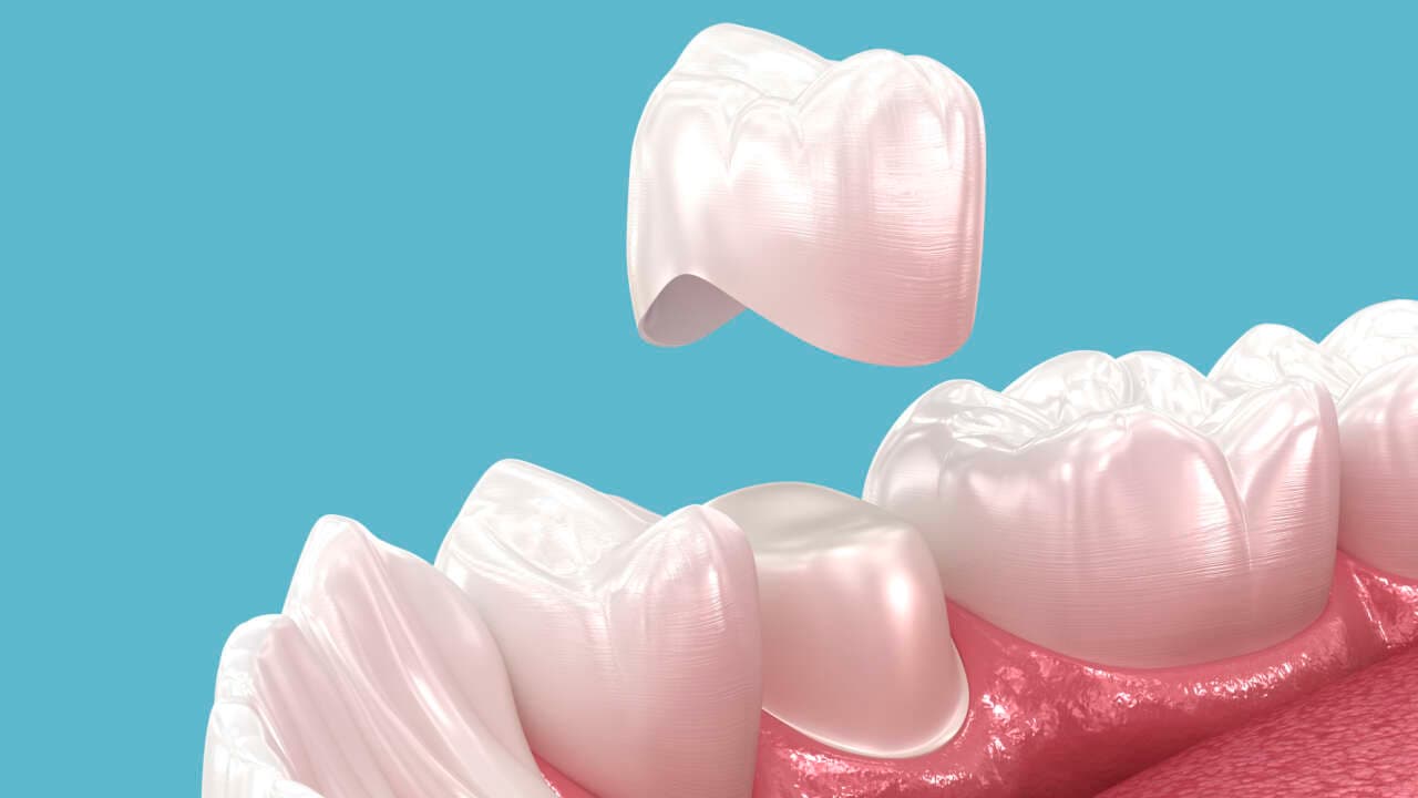 Porcelain Crowns